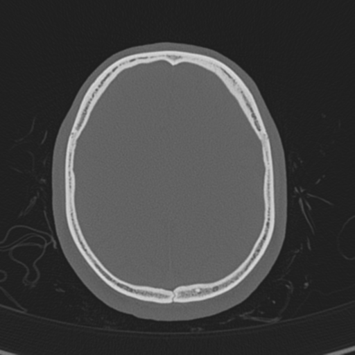 Normal CT skull (Radiopaedia 40798-43459 A 121).png