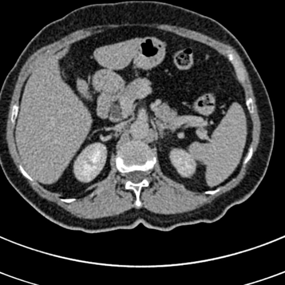 File:Normal CT split bolus study of the renal tract (Radiopaedia 48631-53634 Axial split bolus 34).jpg