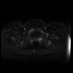 Normal MRI abdomen in pregnancy (Radiopaedia 88005-104548 Axial DWI 81).jpg