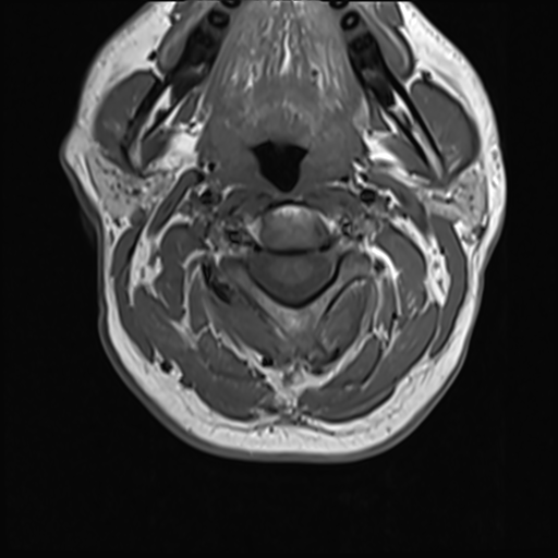 File:Normal MRI cervical spine (infection protocol) (Radiopaedia 53916-60039 Axial 16).png