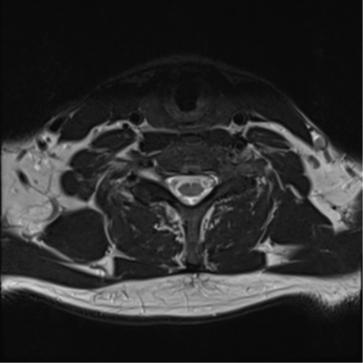 File:Normal MRI cervical spine (infection protocol) (Radiopaedia 53916-60039 Axial T2 37).png
