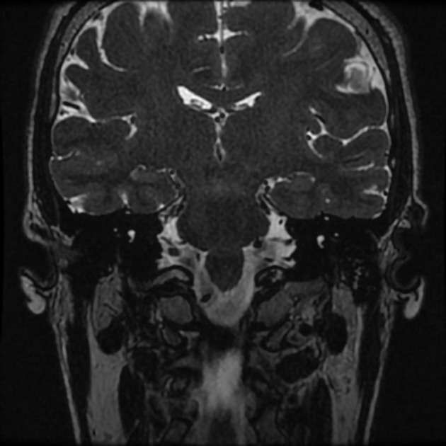 Normal MRI petrous (Radiopaedia 91317-108949 Coronal T2 54).jpg