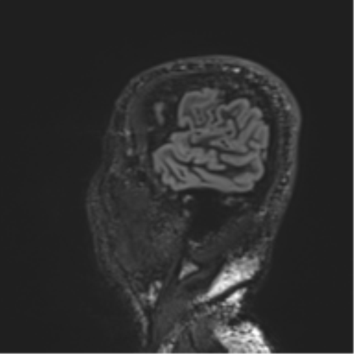 Normal brain MRI (non-focal epilepsy protocol) (Radiopaedia 53917-60040 Sagittal DIR 54).png