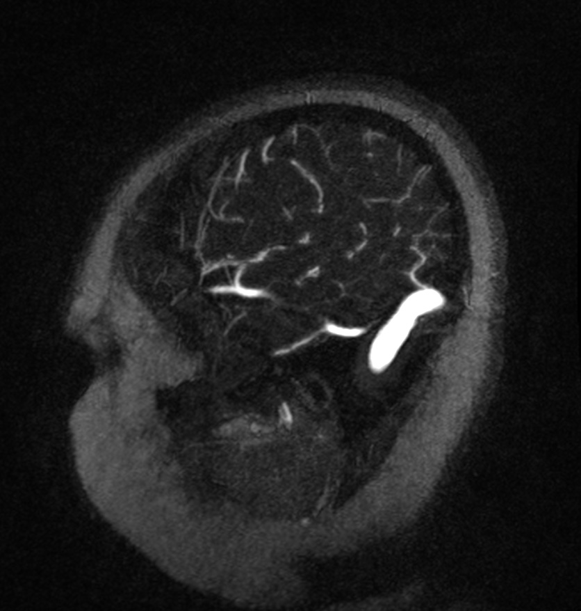 Normal brain MRI and venogram (Radiopaedia 39554-41862 Sagittal MRV 60).jpg