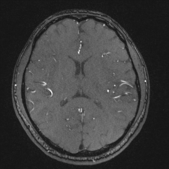 Normal brain MRI including MRA (Radiopaedia 48748-53763 Axial MRA 127).jpg