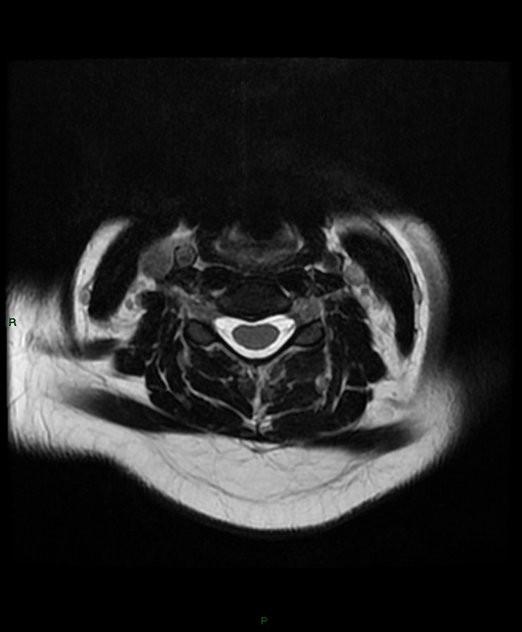 Normal cervical spine MRI (Radiopaedia 80146-93454 Axial T2 45).jpg