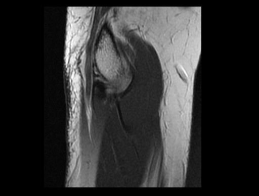 File:Normal elbow arthrograms (Radiopaedia 75550-86805 Sagittal PD 31).jpg