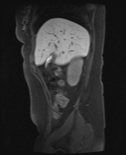 File:Normal hepatobiliary phase liver MRI (Radiopaedia 58968-66230 C 18).jpg