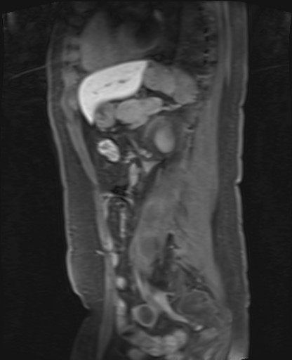 File:Normal hepatobiliary phase liver MRI (Radiopaedia 58968-66230 C 50).jpg