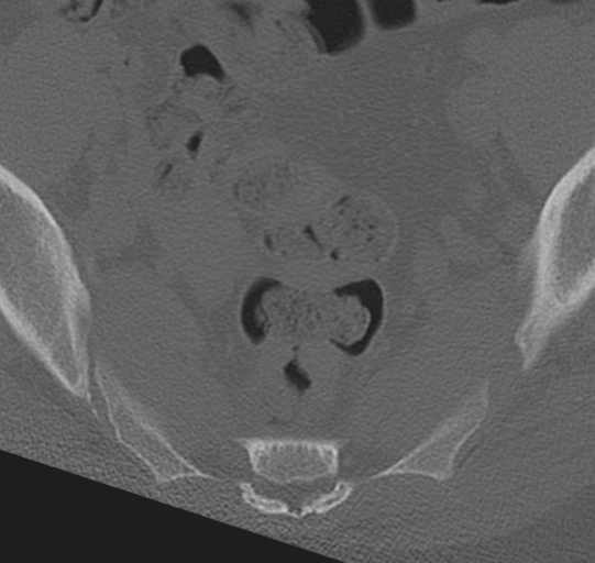 File:Normal lumbar spine CT (Radiopaedia 46533-50986 Axial bone window 82).png