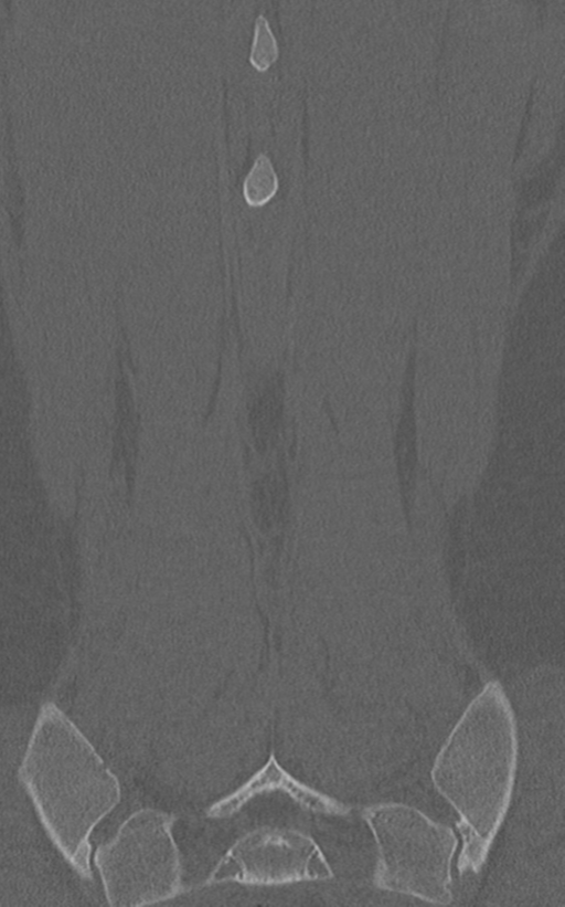 Normal lumbar spine CT (Radiopaedia 46533-50986 Coronal bone window 72).png