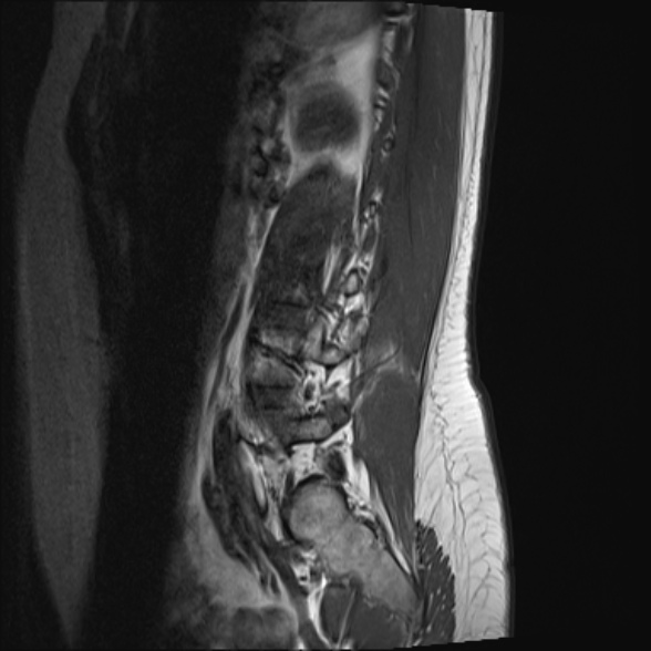 File:Normal lumbar spine MRI- 3 T (Radiopaedia 53280-59250 Sagittal T1 20).jpg