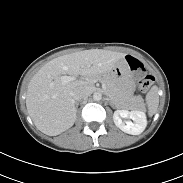 File:Normal multiphase CT liver (Radiopaedia 38026-39996 C 23).jpg