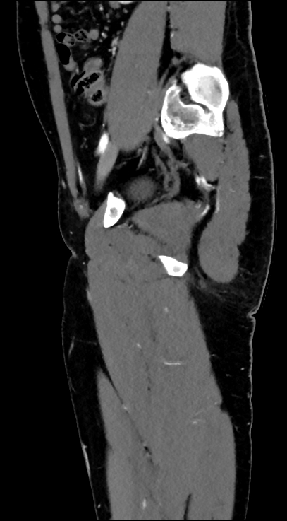 Normal pelvis CT angiogram (Radiopaedia 84966-100481 C 40).jpg