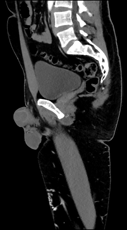 Normal pelvis CT angiogram (Radiopaedia 84966-100481 C 59).jpg