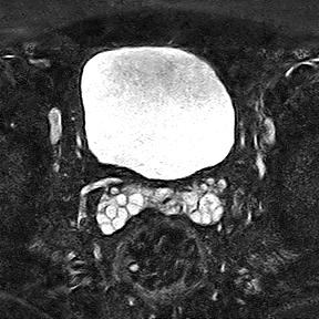 File:Normal prostate (MRI) (Radiopaedia 29986-30535 Axial STIR 20).jpg