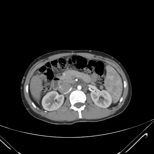 File:Nutmeg liver- Budd-Chiari syndrome (Radiopaedia 46234-50635 A 32).png