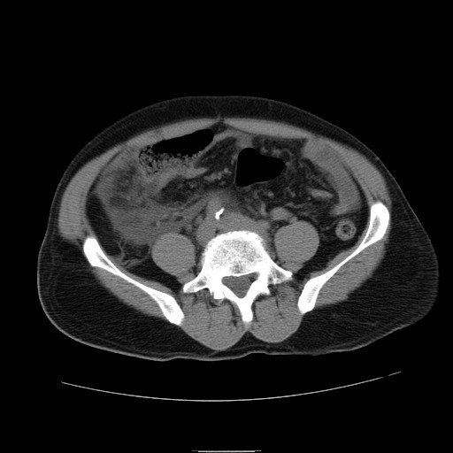 File:Obstructed kidney with perinephric urinoma (Radiopaedia 26889-27066 Axial non-contrast 42).jpg