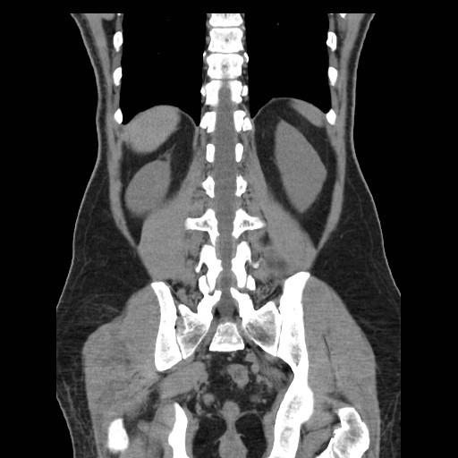 File:Obstructed kidney with perinephric urinoma (Radiopaedia 26889-27067 Coronal non-contrast 24).jpg