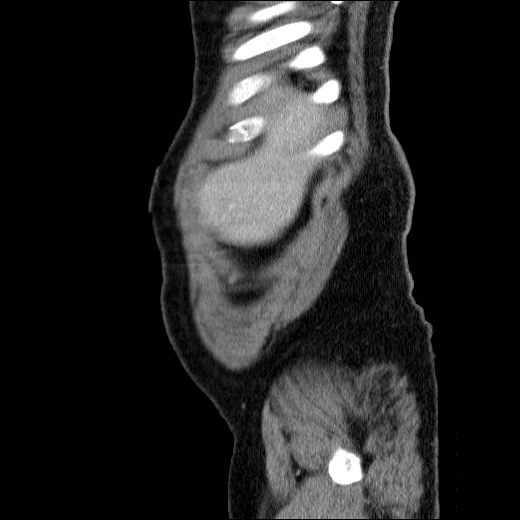 Obstructing ureteric calculus (Radiopaedia 49281-54373 C 80).jpg