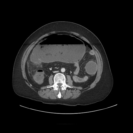 Obstructive distal colonic adenocarcinoma causing cecal perforation (Radiopaedia 86830-102989 A 105).jpg