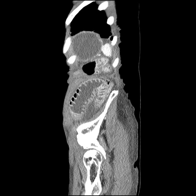 Obturator hernia causing small bowel obstruction (Radiopaedia 65522-74612 C 11).jpg