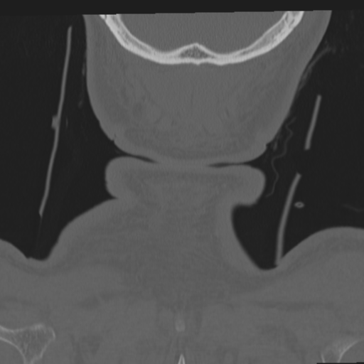 File:Occipital condyle fracture (Radiopaedia 33467-34517 Coronal bone window 76).png