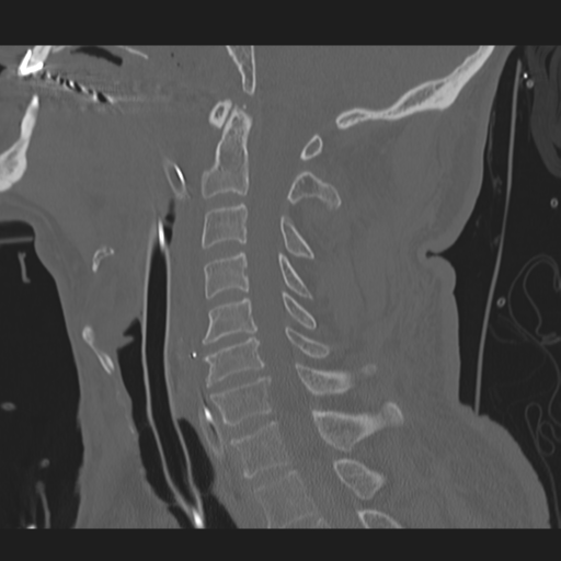 File:Occipital condyle fracture (Radiopaedia 33467-34517 Sagittal bone window 37).png