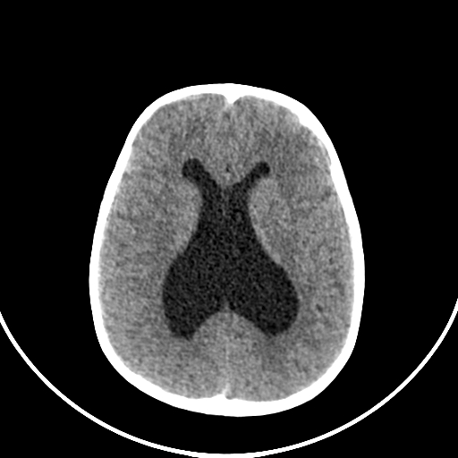 Occipital encephalocele (Radiopaedia 87339-103636 Axial non-contrast 51).jpg