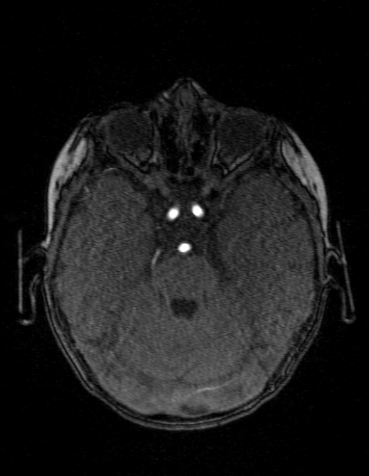 Occipital horn syndrome (Radiopaedia 14255-14129 MRA 50).jpg