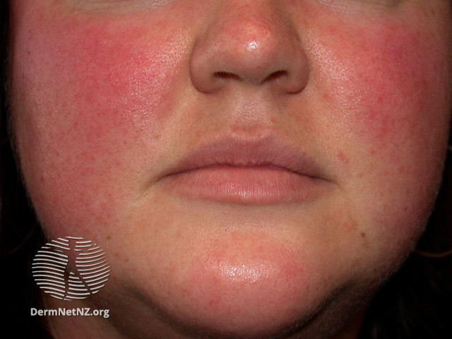 Rosacea (DermNet NZ acne-red-face-3625).jpg
