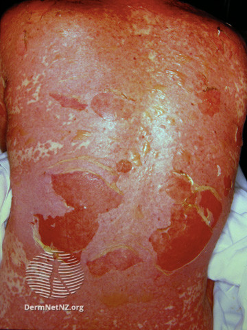 File:Toxic epidermal necrolysis (DermNet NZ reactions-ten1).jpg