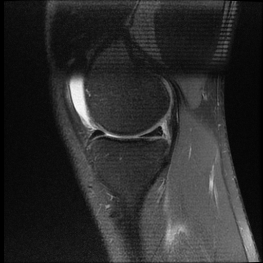 File:ACL acute full thickness tear - deep lateral femoral sulcus sign (Radiopaedia 38594-40740 Sagittal PD fat sat 6).jpg