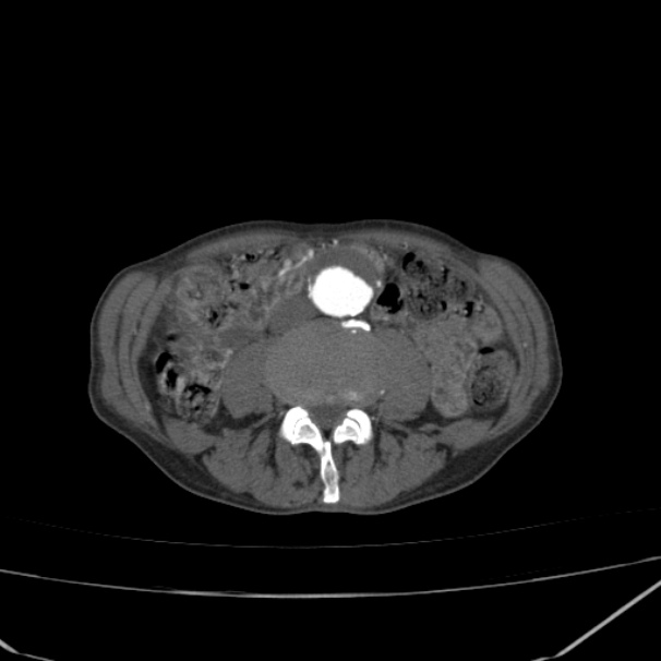 Abdominal aortic aneurysm (Radiopaedia 23703-23856 Axial C+ arterial phase 47).jpg