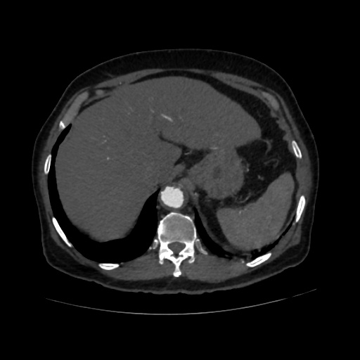 File:Abdominal aortic aneurysm (Radiopaedia 57318-64259 Axial C+ arterial phase 13).jpg