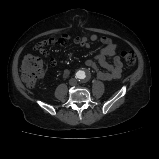 File:Abdominal aortic aneurysm (Radiopaedia 57318-64259 Axial C+ arterial phase 47).jpg