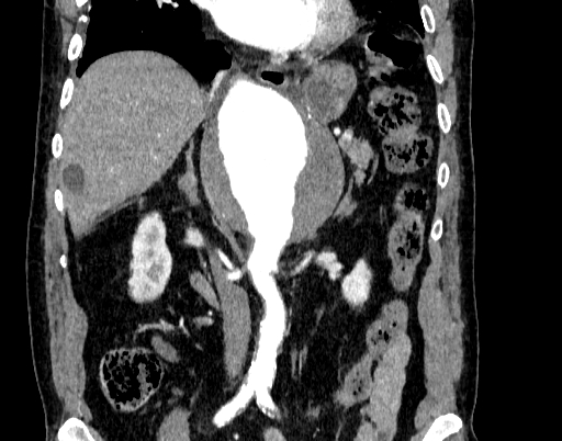 Abdominal aortic aneurysm (Radiopaedia 67117-76452 Coronal C+ arterial phase 48).jpg