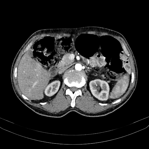Abdominal aortic aneurysm (Radiopaedia 83581-98689 Axial C+ arterial phase 44).jpg