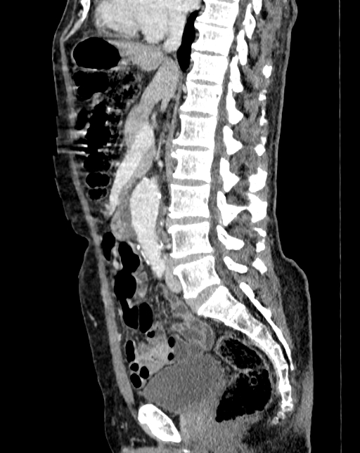 Abdominal aortic aneurysm (Radiopaedia 83581-98689 Sagittal C+ portal venous phase 44).jpg