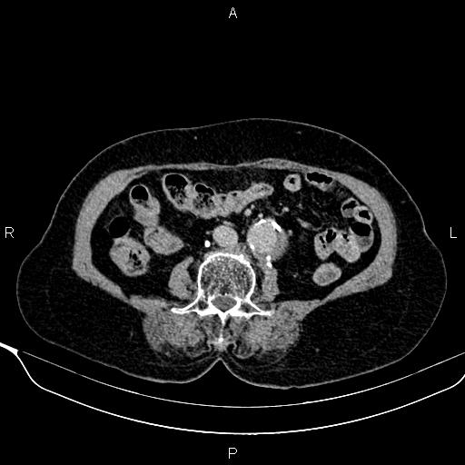 File:Abdominal aortic aneurysm (Radiopaedia 85063-100606 Axial C+ delayed 66).jpg