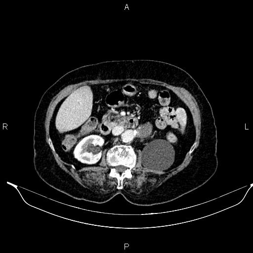 File:Abdominal aortic aneurysm (Radiopaedia 85063-100606 Axial C+ portal venous phase 38).jpg