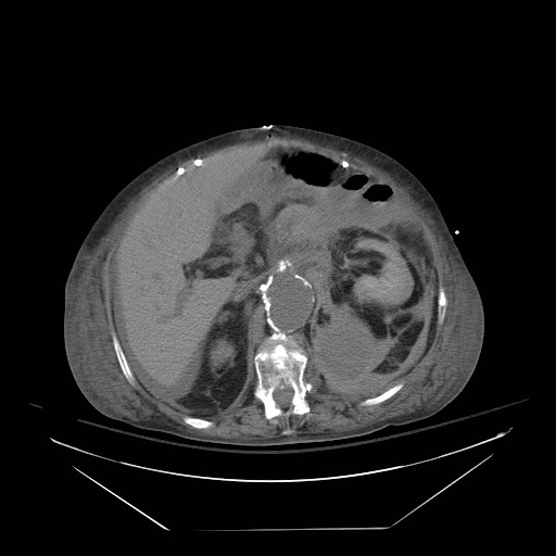Abdominal aortic aneurysm - impending rupture (Radiopaedia 19233-19247 Axial non-contrast 63).jpg