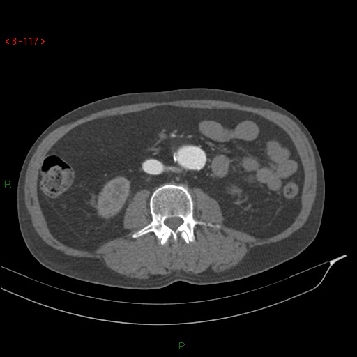 File:Abdominal aortic aneurysm rupture with aortocaval fistula (Radiopaedia 14897-14841 Axial C+ arterial phase 117).jpg
