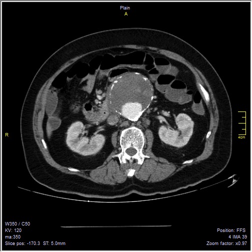 Abdominal aortic aneurysm with thrombus fissuration (Radiopaedia 47340-51926 Axial C+ arterial phase 23).jpg