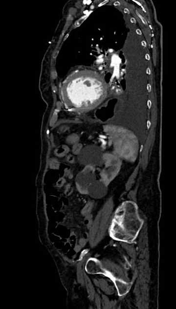 Abdominal aortic aneurysm with thrombus fissuration (Radiopaedia 73192-83919 Sagittal C+ arterial phase 37).jpg