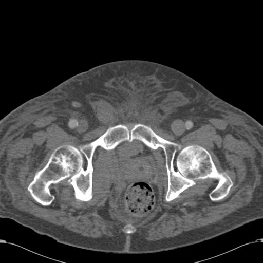 Abdominal hematoma (Radiopaedia 33614-34715 Axial C+ portal venous phase 130).png