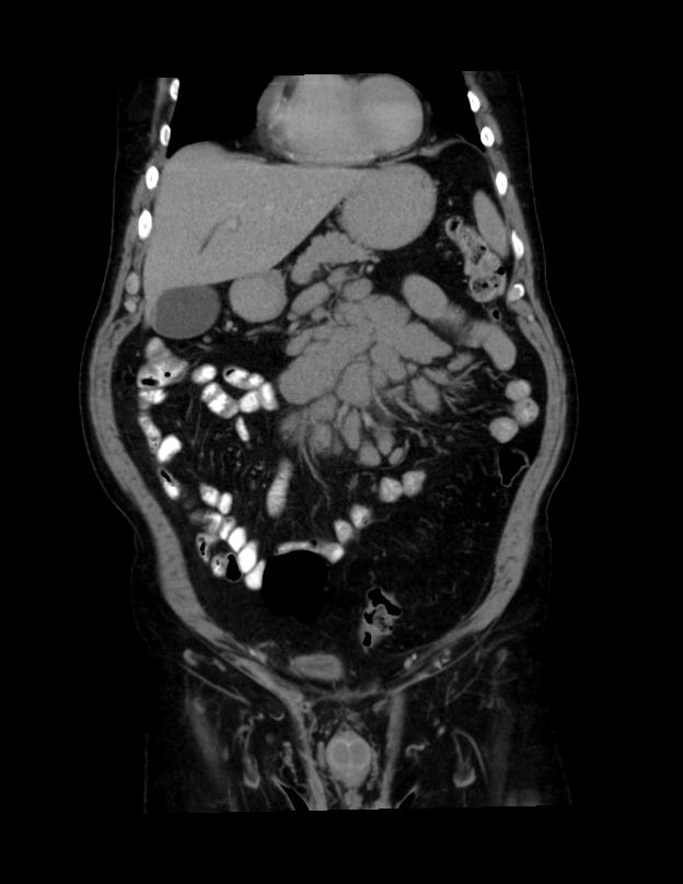 Abdominal lymphoma - with sandwich sign (Radiopaedia 53486-59492 C+ portal venous phase 41).jpg