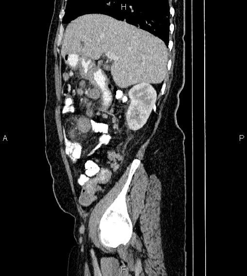 Abdominal lymphoma with sandwich sign (Radiopaedia 84378-99704 Sagittal C+ portal venous phase 20).jpg
