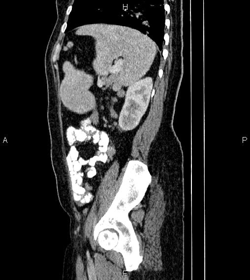 Abdominal lymphoma with sandwich sign (Radiopaedia 84378-99704 Sagittal C+ portal venous phase 71).jpg