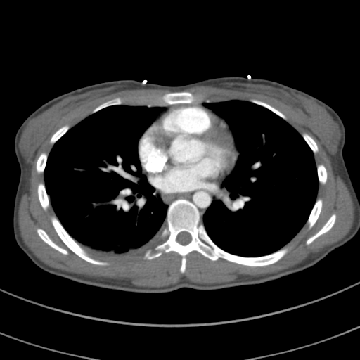 File:Abdominal multi-trauma - devascularised kidney and liver, spleen and pancreatic lacerations (Radiopaedia 34984-36486 Axial C+ arterial phase 47).png